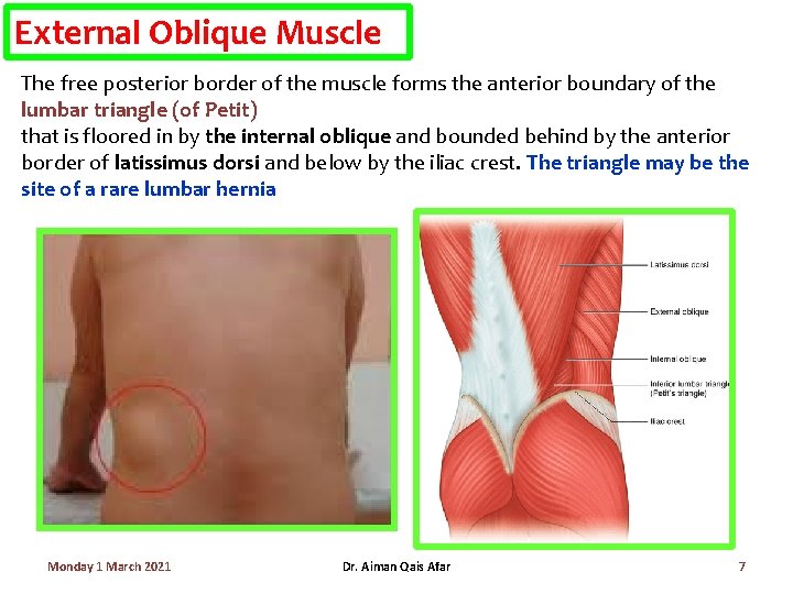 External Oblique Muscle The free posterior border of the muscle forms the anterior boundary