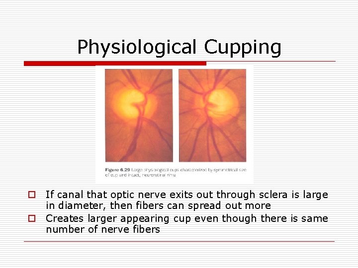 Physiological Cupping o If canal that optic nerve exits out through sclera is large