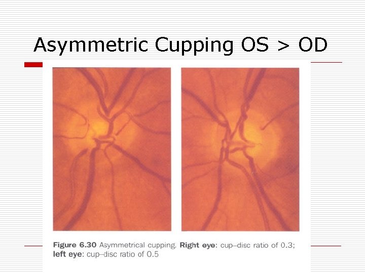 Asymmetric Cupping OS > OD 