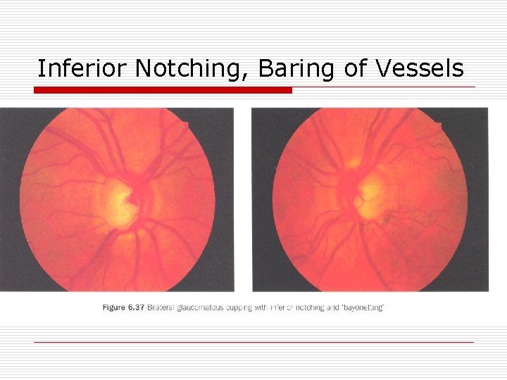 Inferior Notching, Baring of Vessels 