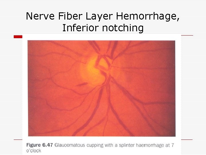 Nerve Fiber Layer Hemorrhage, Inferior notching 