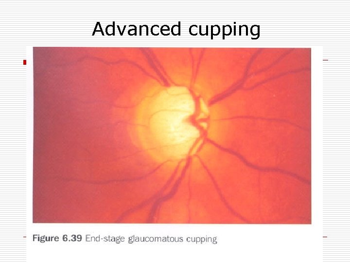 Advanced cupping 