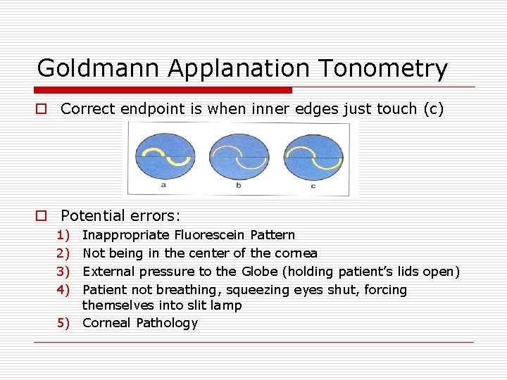 Goldmann Applanation Tonometry o Correct endpoint is when inner edges just touch (c) o