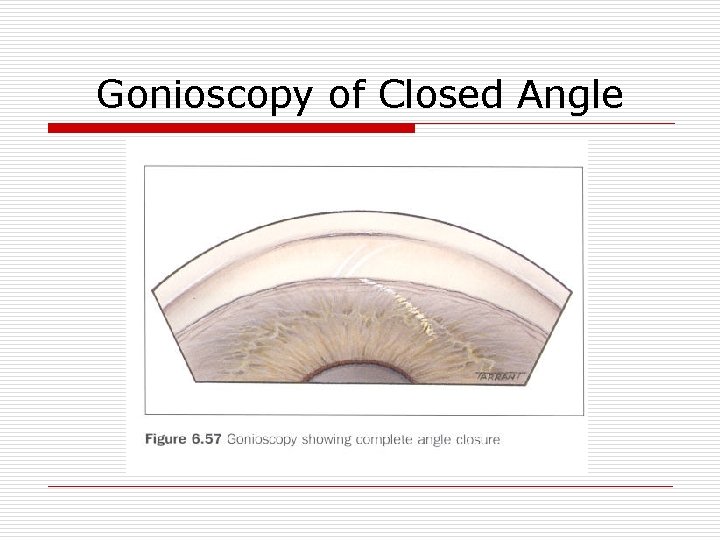 Gonioscopy of Closed Angle 