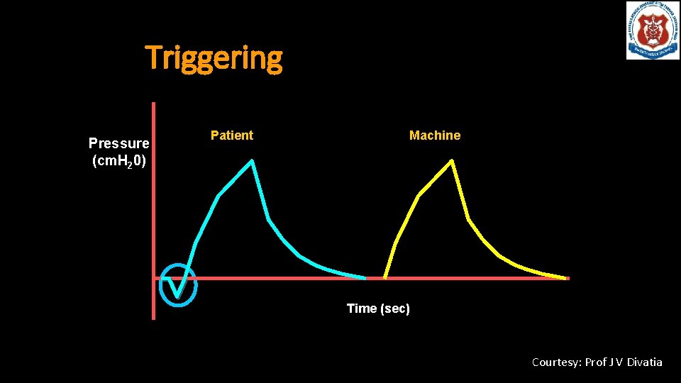 Triggering Pressure (cm. H 20) Patient Machine Time (sec) Courtesy: Prof J V Divatia