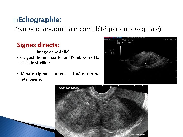 � Echographie: (par voie abdominale complété par endovaginale) Signes directs: (image annexielle) • Sac