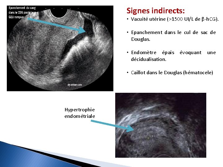 Signes indirects: • Vacuité utérine (>1500 UI/L de β-h. CG). • Epanchement dans le