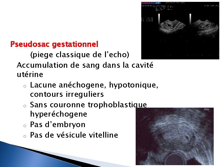 Pseudosac gestationnel (piege classique de l’echo) Accumulation de sang dans la cavité utérine o