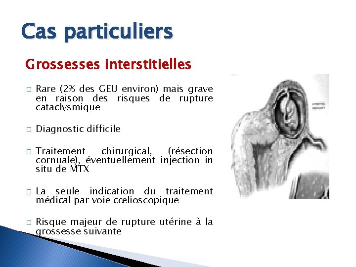 Cas particuliers Grossesses interstitielles � � � Rare (2% des GEU environ) mais grave