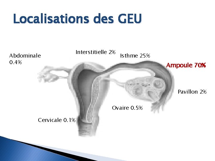 Localisations des GEU Abdominale 0. 4% Interstitielle 2% Isthme 25% Ampoule 70% Pavillon 2%