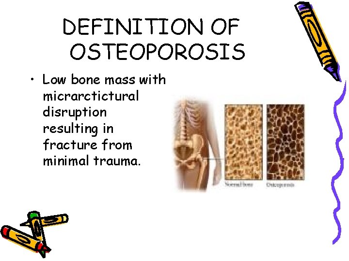DEFINITION OF OSTEOPOROSIS • Low bone mass with micrarctictural disruption resulting in fracture from