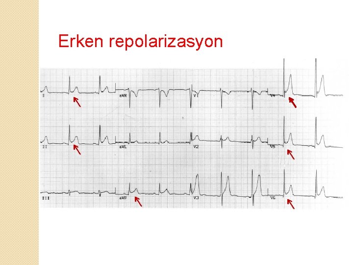 Erken repolarizasyon 