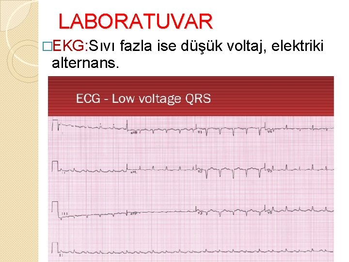 LABORATUVAR �EKG: Sıvı fazla ise düşük voltaj, elektriki alternans. 