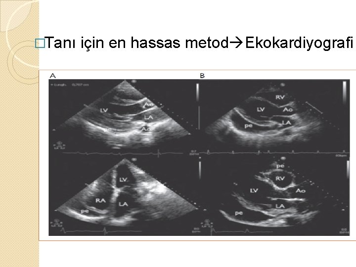�Tanı için en hassas metod Ekokardiyografi 
