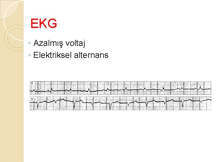 EKG ◦ Azalmış voltaj ◦ Elektriksel alternans 