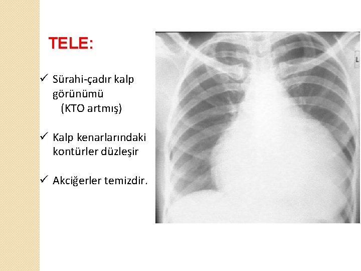 TELE: ü Sürahi-çadır kalp görünümü (KTO artmış) ü Kalp kenarlarındaki kontürler düzleşir ü Akciğerler