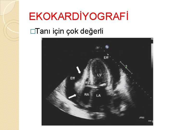 EKOKARDİYOGRAFİ �Tanı için çok değerli 