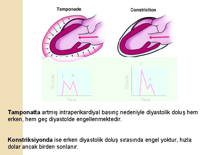 Tamponatta artmış intraperikardiyal basınç nedeniyle diyastolik doluş hem erken, hem geç diyastolde engellenmektedir. Konstriksiyonda