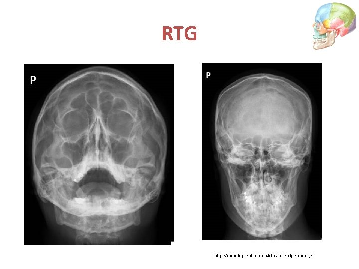 RTG http: //radiologieplzen. eu/klasicke-rtg-snimky/ 