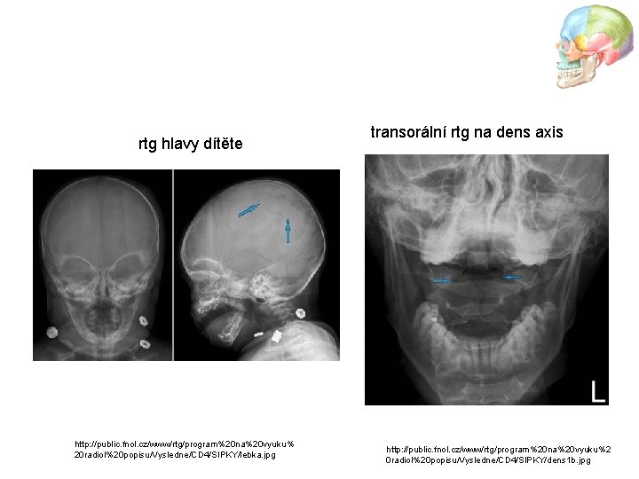 rtg hlavy dítěte http: //public. fnol. cz/www/rtg/program%20 na%20 vyuku% 20 radiol%20 popisu/Vysledne/CD 4/SIPKY/lebka. jpg