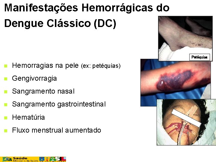 Manifestações Hemorrágicas do Dengue Clássico (DC) Petéquias n Hemorragias na pele (ex: petéquias) n