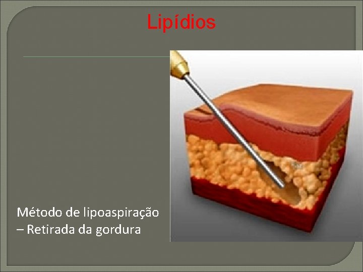 Lipídios Método de lipoaspiração – Retirada da gordura 