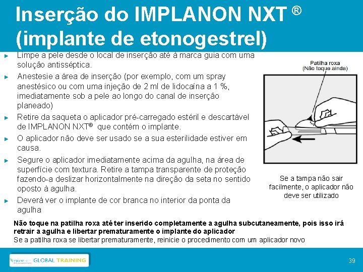 Inserção do IMPLANON NXT ® (implante de etonogestrel) ► ► ► Limpe a pele
