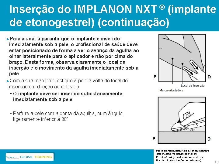 Inserção do IMPLANON NXT ® (implante de etonogestrel) (continuação) ►Para ajudar a garantir que