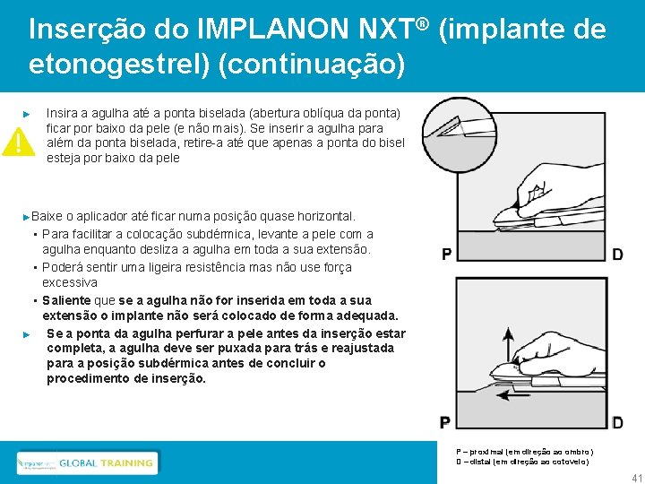 Inserção do IMPLANON NXT® (implante de etonogestrel) (continuação) ► Insira a agulha até a