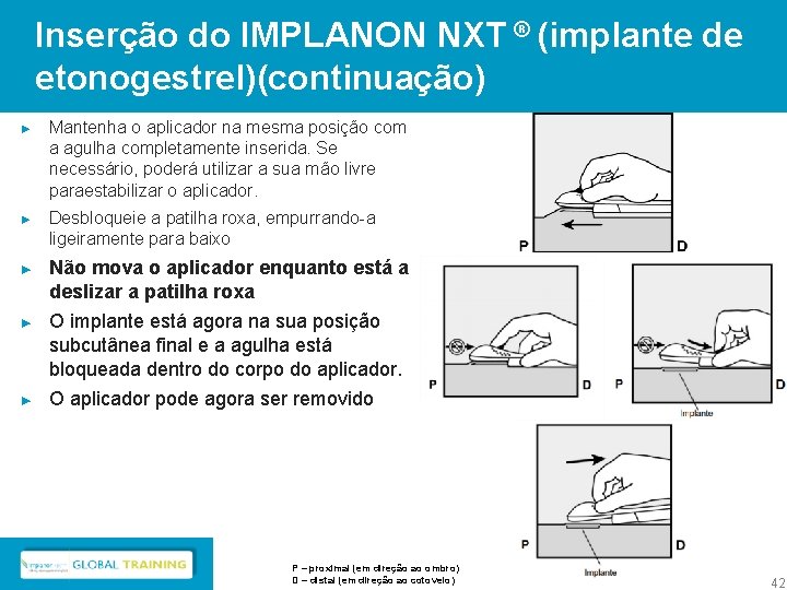 Inserção do IMPLANON NXT ® (implante de etonogestrel)(continuação) ► Mantenha o aplicador na mesma