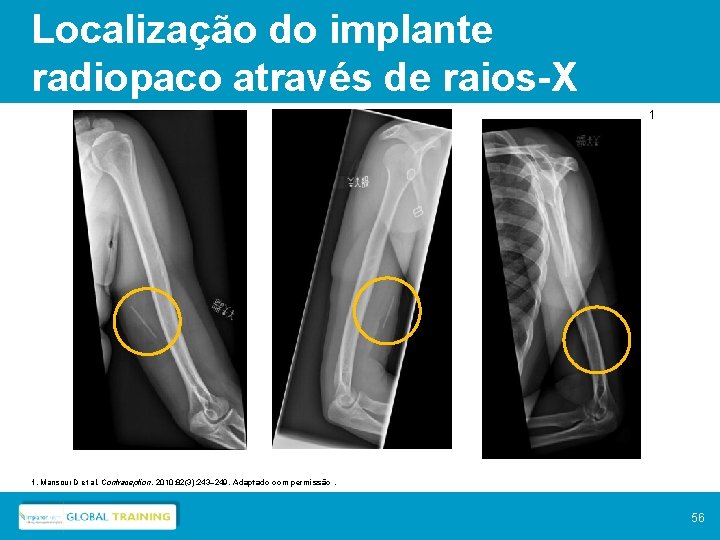 Localização do implante radiopaco através de raios-X 1 1. Mansour D et al. Contraception.