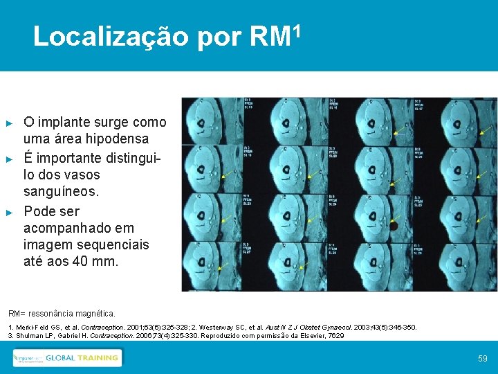 Localização por RM 1 ► ► ► O implante surge como uma área hipodensa