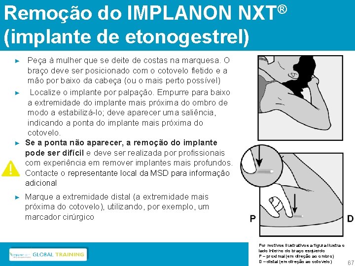 Remoção do IMPLANON NXT® (implante de etonogestrel) ► ► Peça à mulher que se