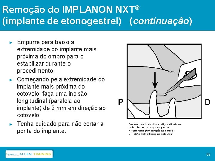 Remoção do IMPLANON NXT® (implante de etonogestrel) (continuação) ► ► ► Empurre para baixo