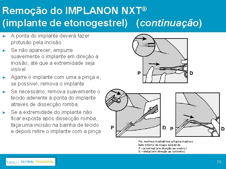 Remoção do IMPLANON NXT® (implante de etonogestrel) (continuação) ► ► ► A ponta do