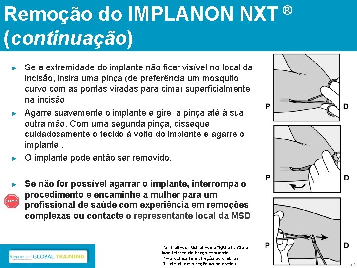 Remoção do IMPLANON NXT ® (continuação) ► ► Se a extremidade do implante não