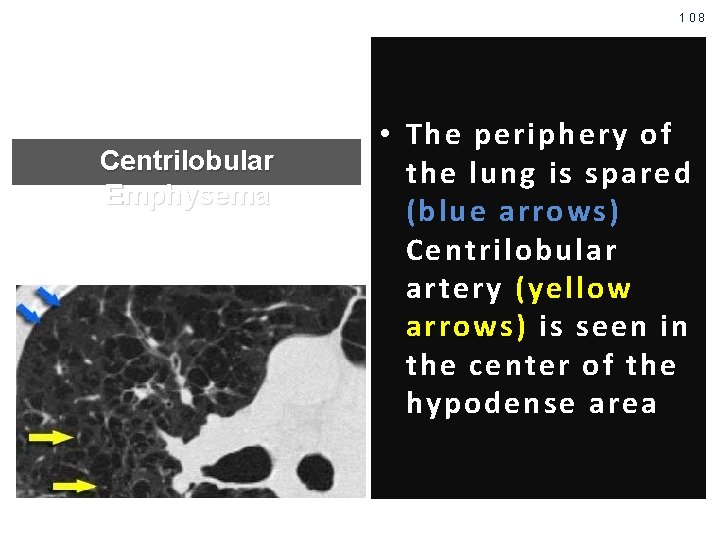 108 Centrilobular Emphysema • The periphery of the lung is spared (blue arrows )