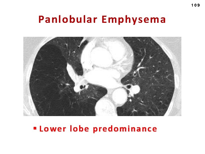 109 Panlobular Emphysema § Lower lobe predominance 