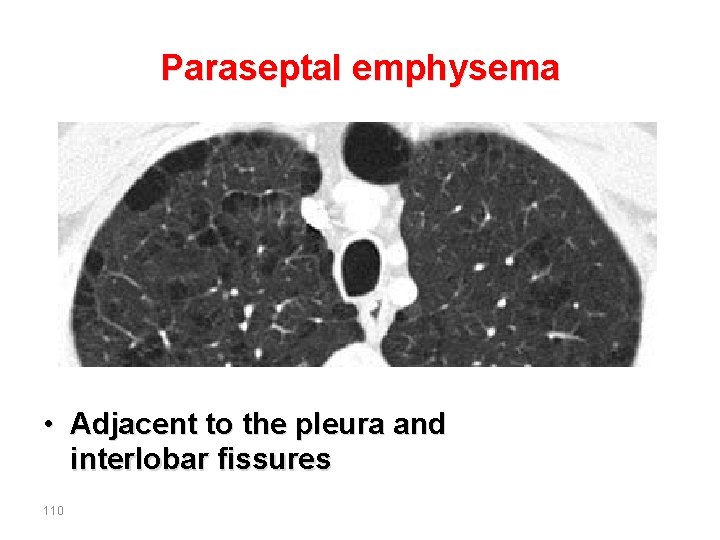 Paraseptal emphysema • Adjacent to the pleura and interlobar fissures 110 