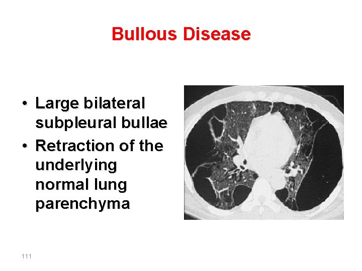 Bullous Disease • Large bilateral subpleural bullae • Retraction of the underlying normal lung