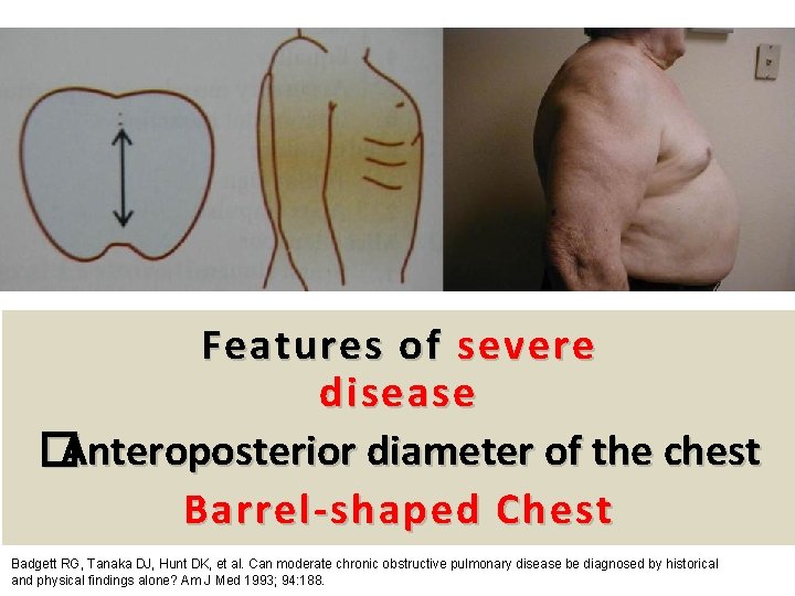 39 Features of severe disease �Anteroposterior diameter of the chest Barrel-shaped Chest Badgett RG,