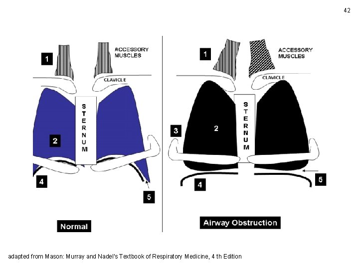 42 adapted from Mason: Murray and Nadel's Textbook of Respiratory Medicine, 4 th Edition