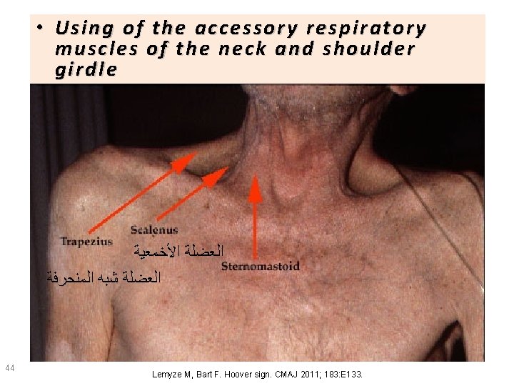  • Using of the accessory respir atory respira tory muscle muscl ess of