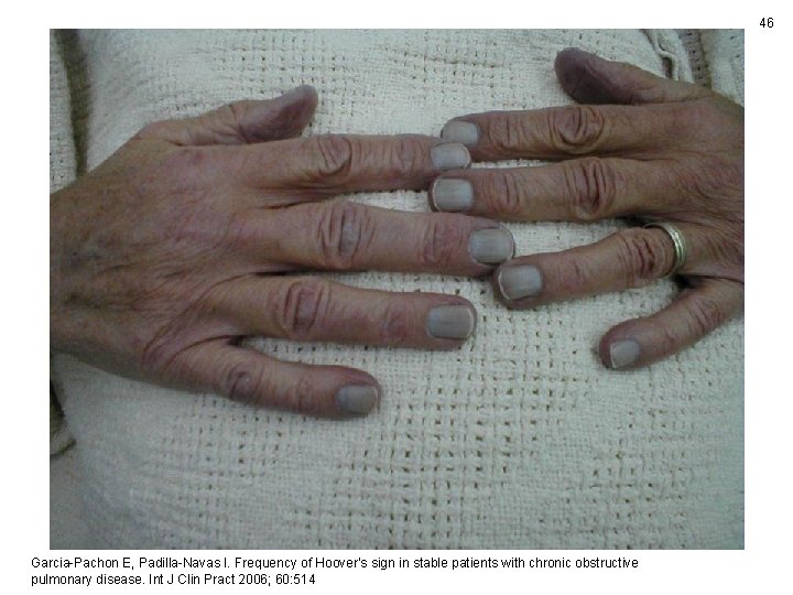 46 Garcia-Pachon E, Padilla-Navas I. Frequency of Hoover's sign in stable patients with chronic