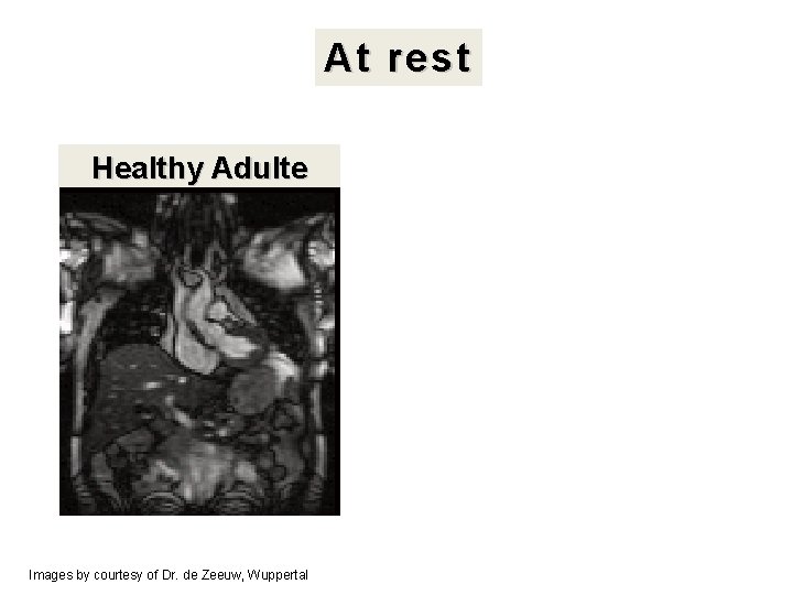 At rest Healthy Adulte Images by courtesy of Dr. de Zeeuw, Wuppertal Fixed airway
