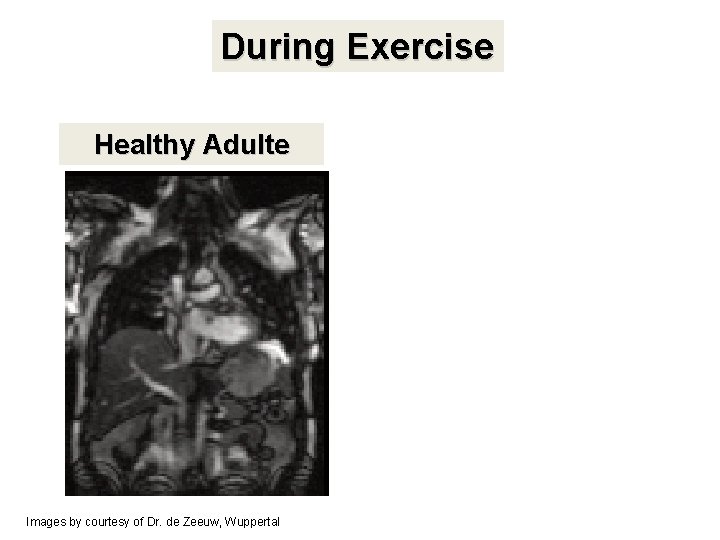 During Exercise Healthy Adulte Images by courtesy of Dr. de Zeeuw, Wuppertal Fixed airway