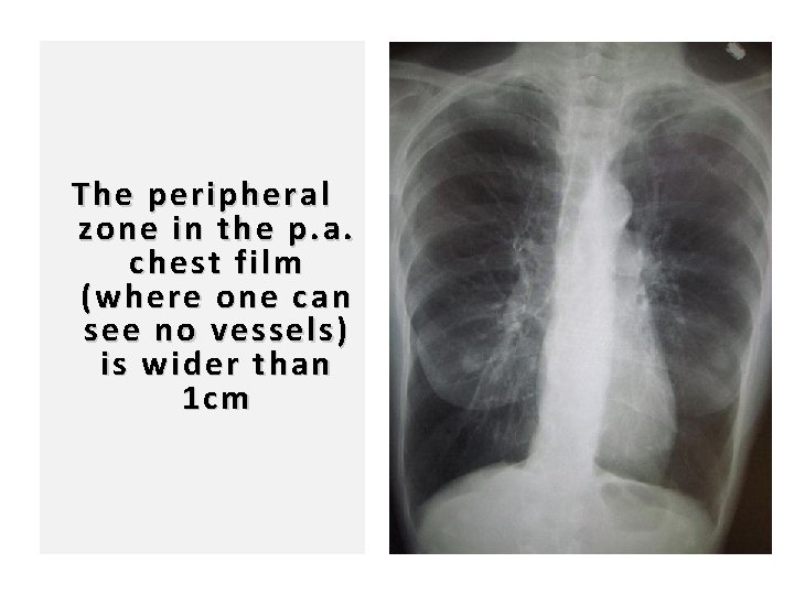 97 The peripheral zone in the p. a. chest film (where one can see