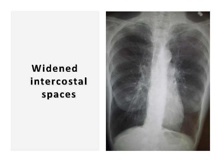 98 Widened intercostal spaces 