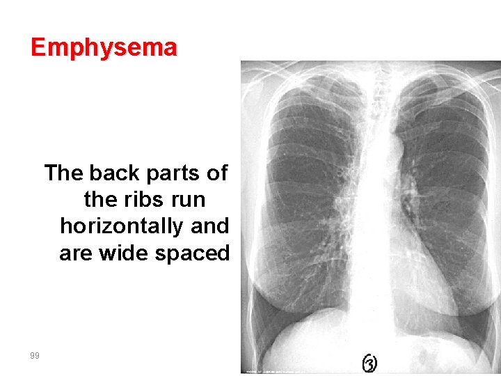 Emphysema The back parts of the ribs run horizontally and are wide spaced 99
