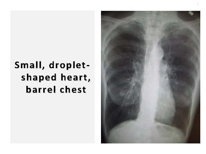 100 Small, dropletshaped heart, barrel chest 